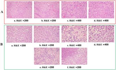 Sarcomatoid carcinoma transformation in oral undifferentiated carcinoma following sequential immune combined targeted therapy: a case report